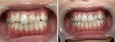 審美歯科の治療例